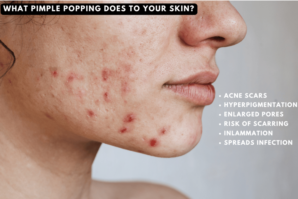 64 pimple popping- hidden dangers