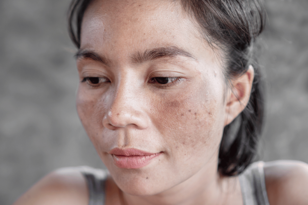 reverse sun damage naturally-3